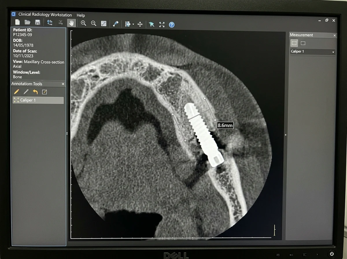 After treatment