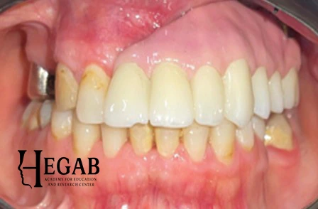 After treatment