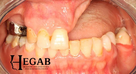 Before treatment