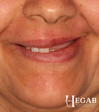 Before treatment