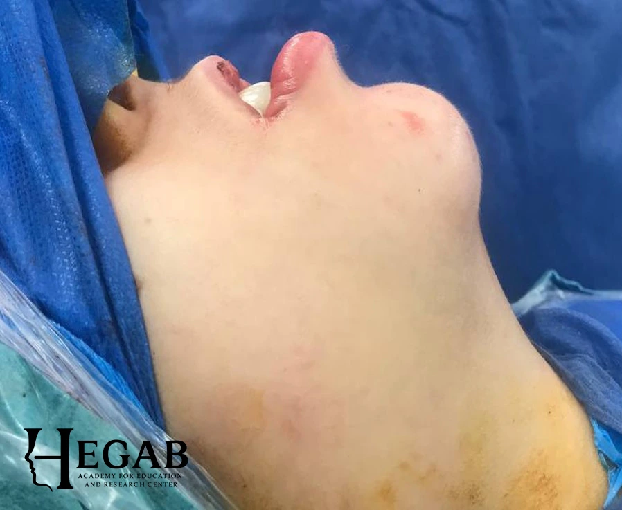 After treatment