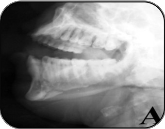 Extra-oral MultiDirectional Distractor: A Multi Uses Distractor4