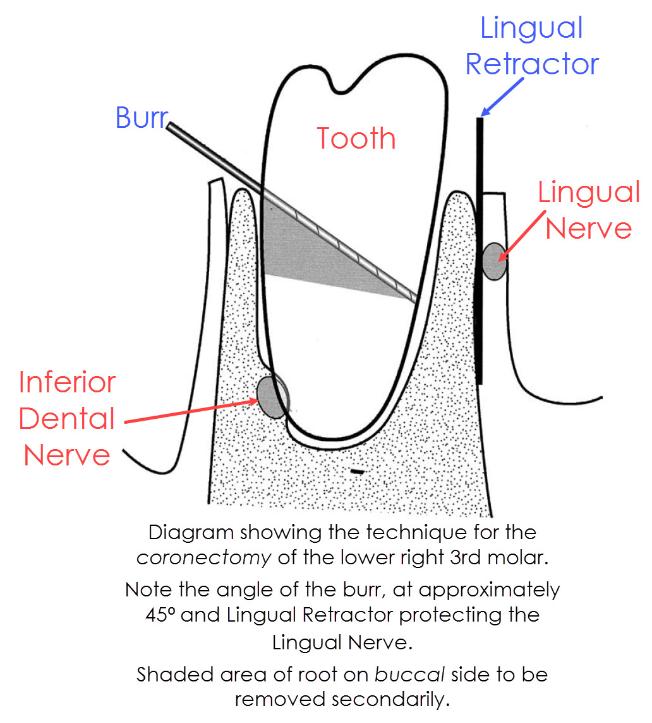 Coronectomy / Intentional Partial Odontectomy19