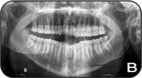 Extra-oral MultiDirectional Distractor: A Multi Uses Distractor5