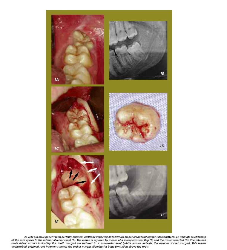 Coronectomy / Intentional Partial Odontectomy1