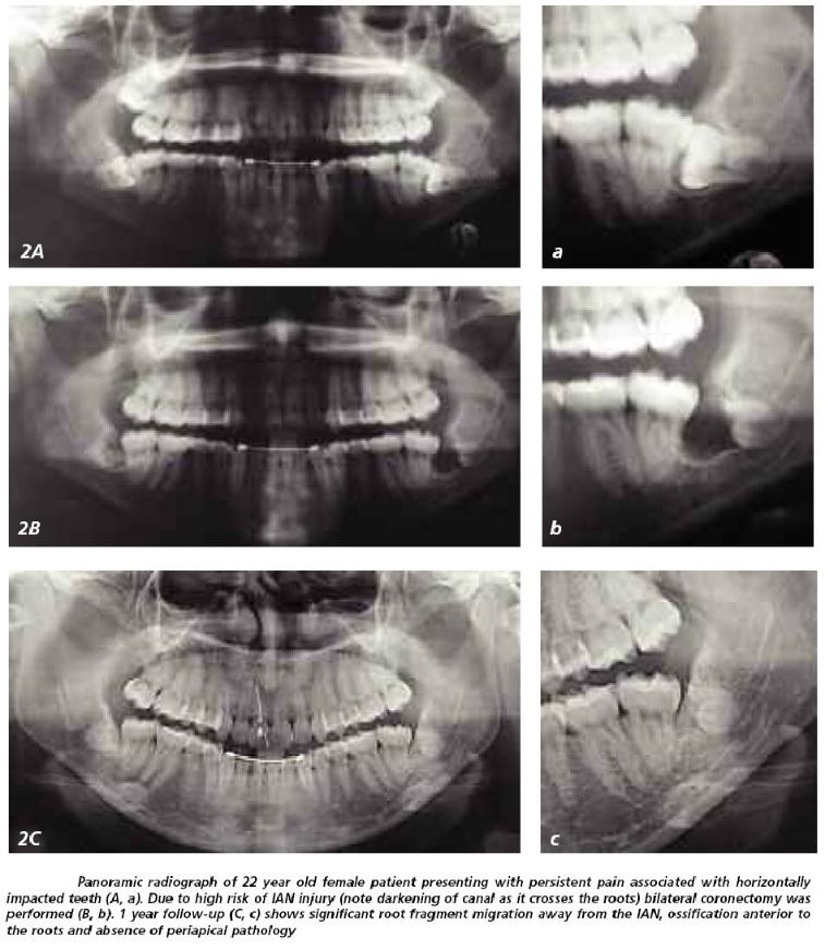 Coronectomy / Intentional Partial Odontectomy2