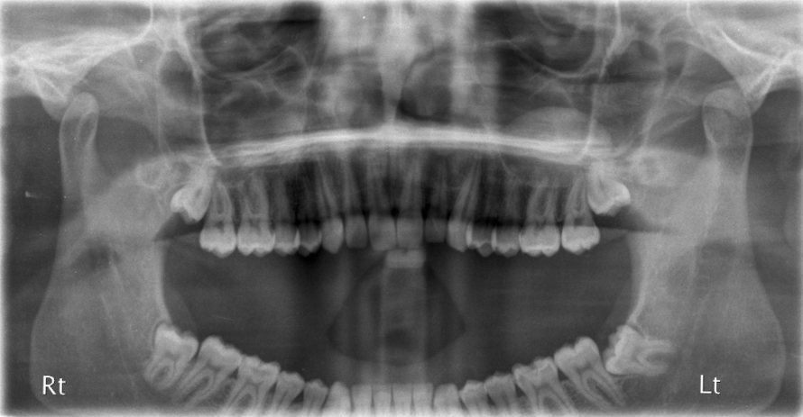 Tooth Removal Warnings56