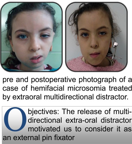 Extra-oral MultiDirectional Distractor: A Multi Uses Distractor2