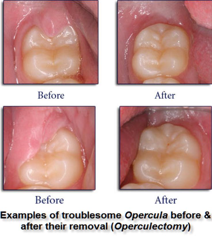 Operculectomy6