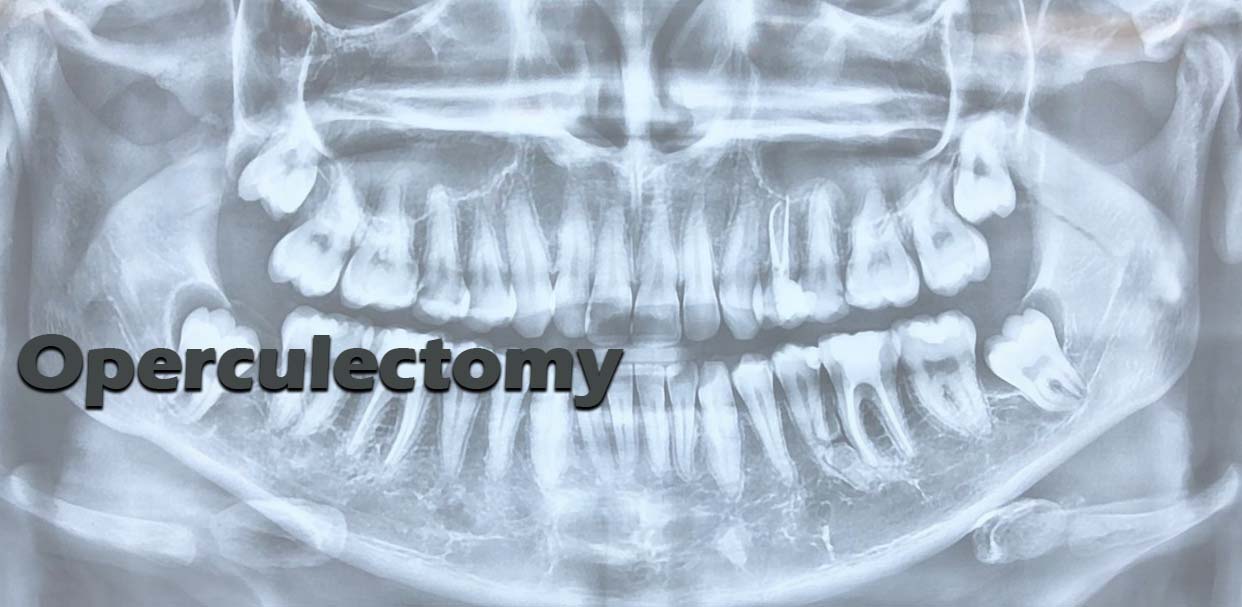 Operculectomy