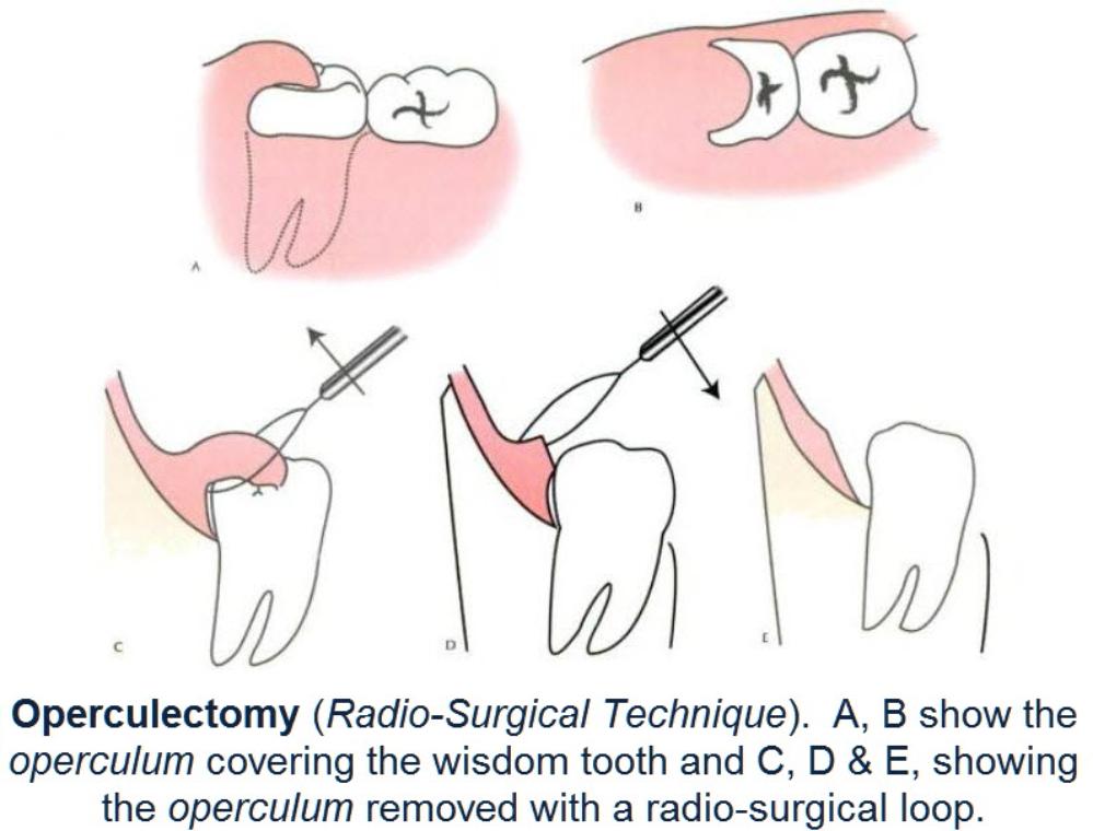 Operculectomy40