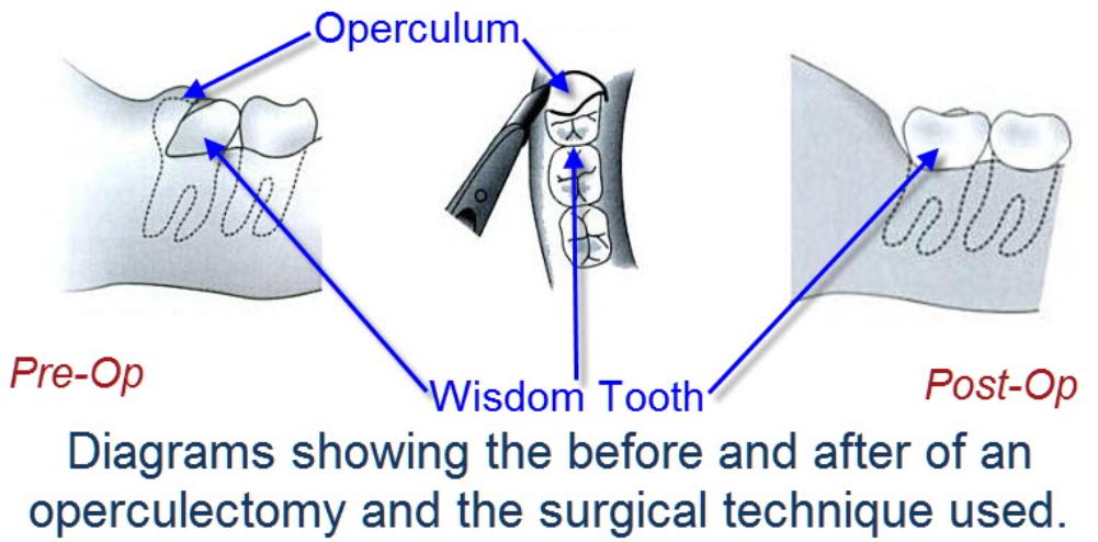 Operculectomy25