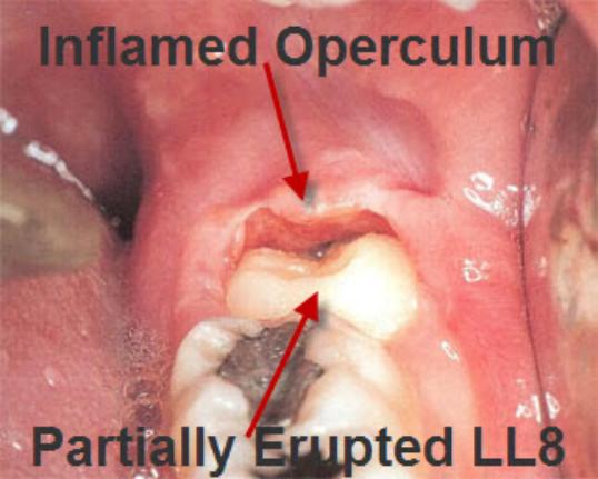 Operculectomy5