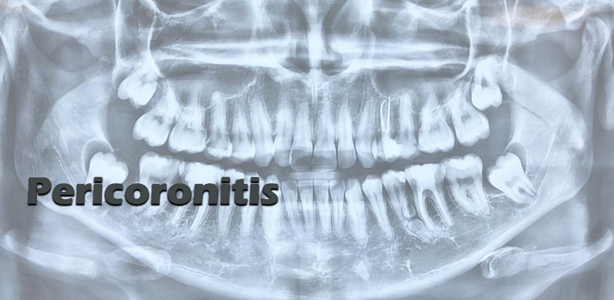 Pericoronitis