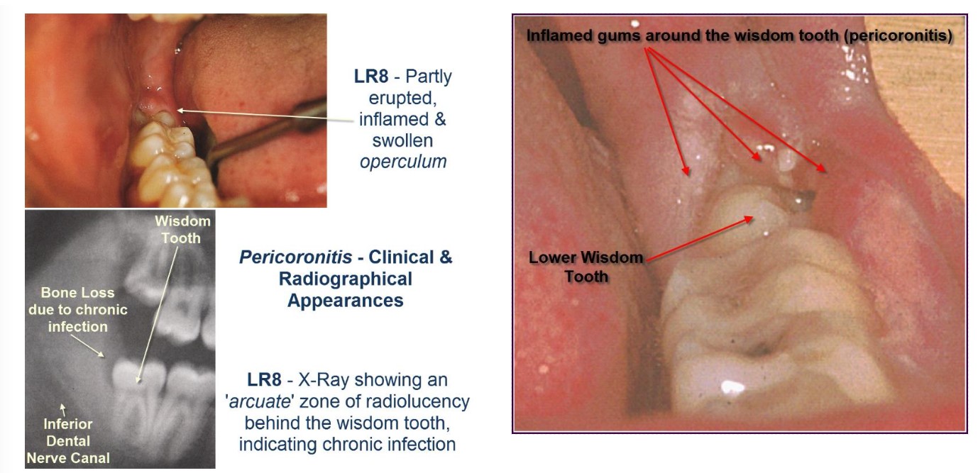 Pericoronitis8