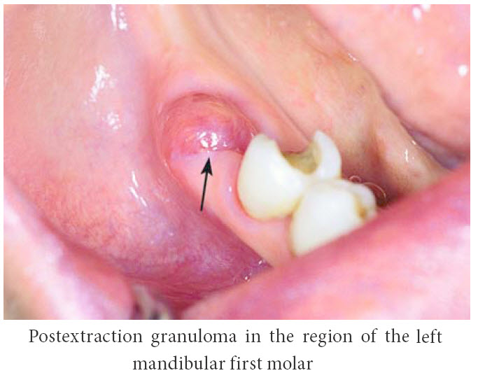 Tooth Removal Warnings51