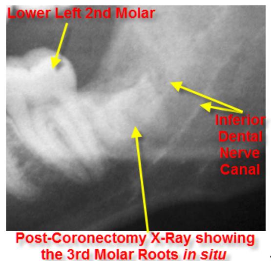 Coronectomy / Intentional Partial Odontectomy3