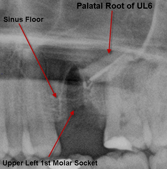 Tooth Removal Warnings26