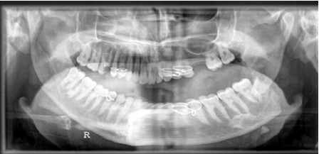 Relationship between Fractures of Mandibular Angle and the Presence of a Lower Third Molar15