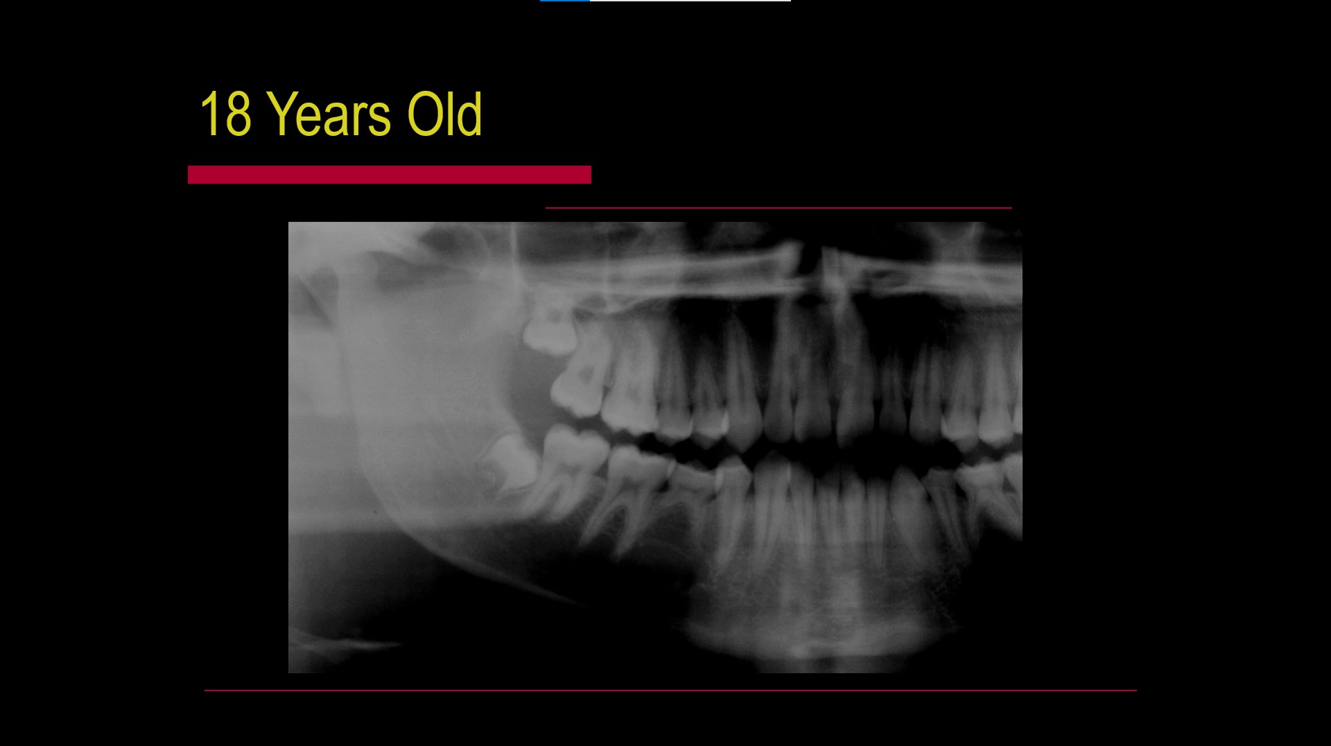 Impacted teeth1