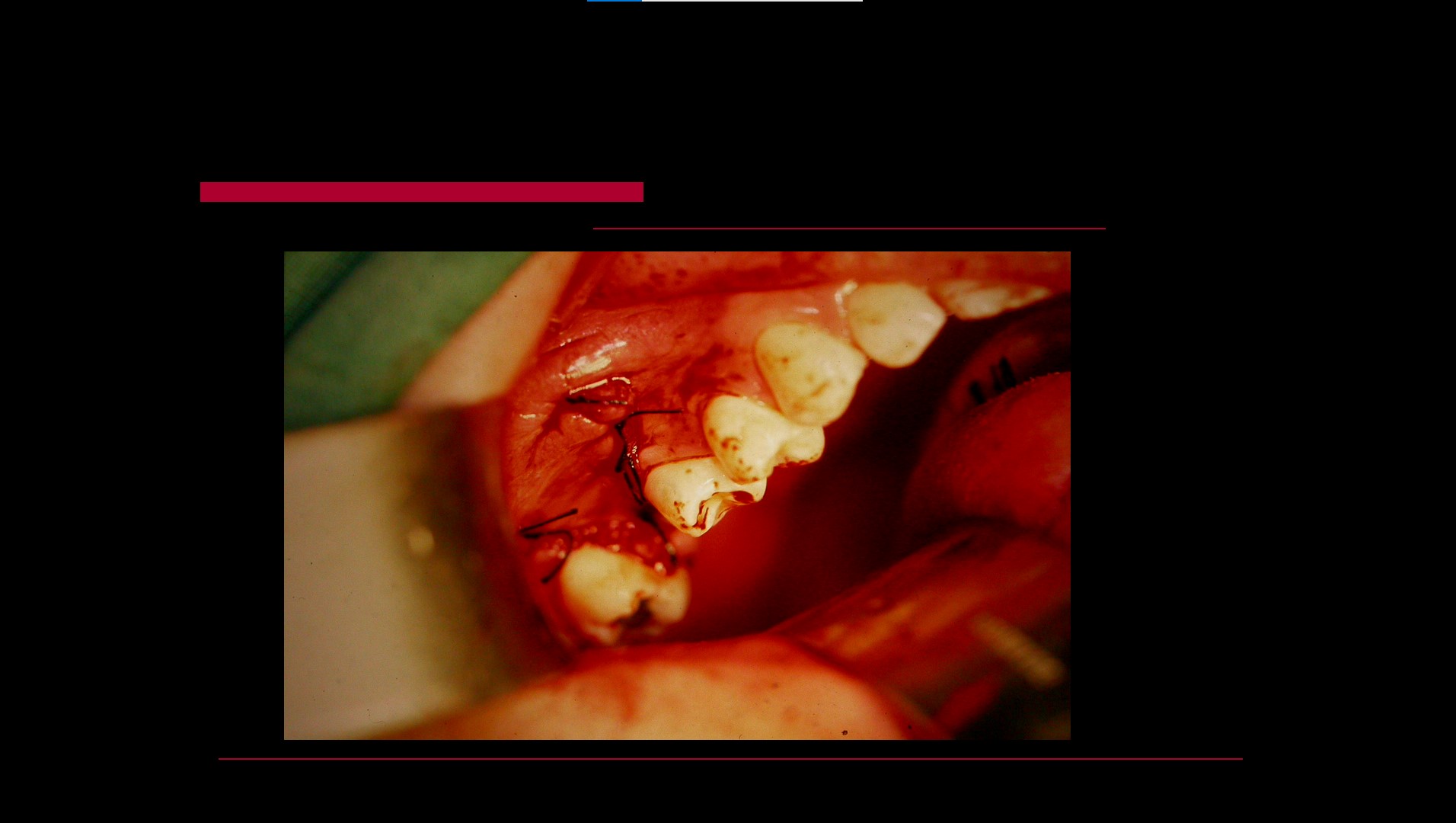 Impacted teeth5