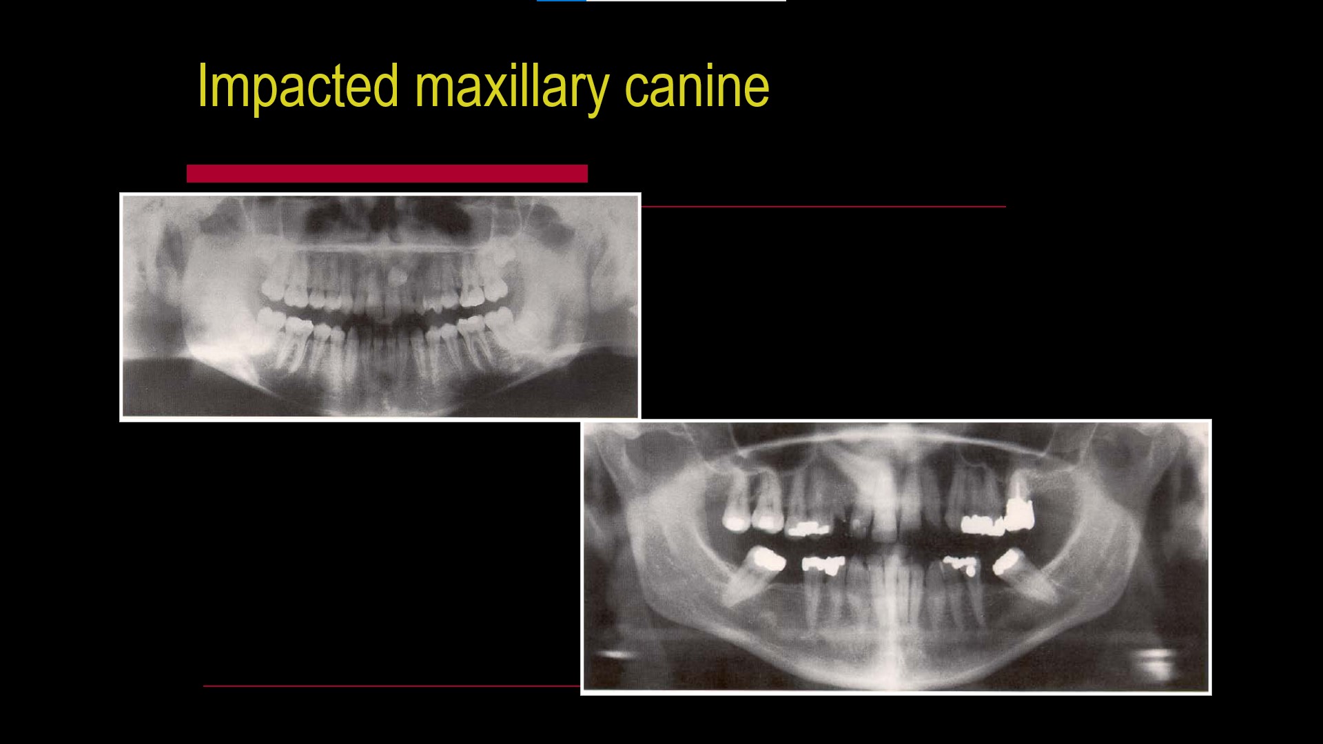 Impacted teeth5