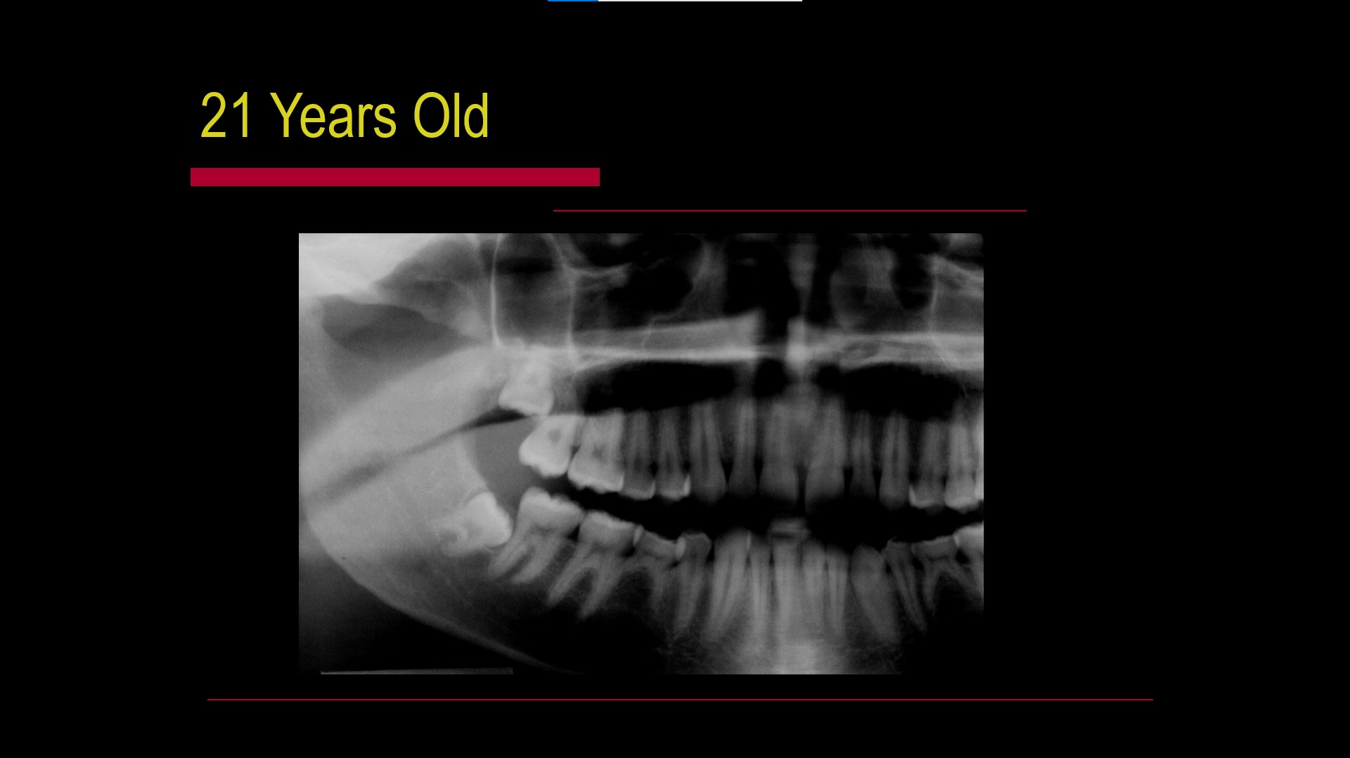 Impacted teeth1