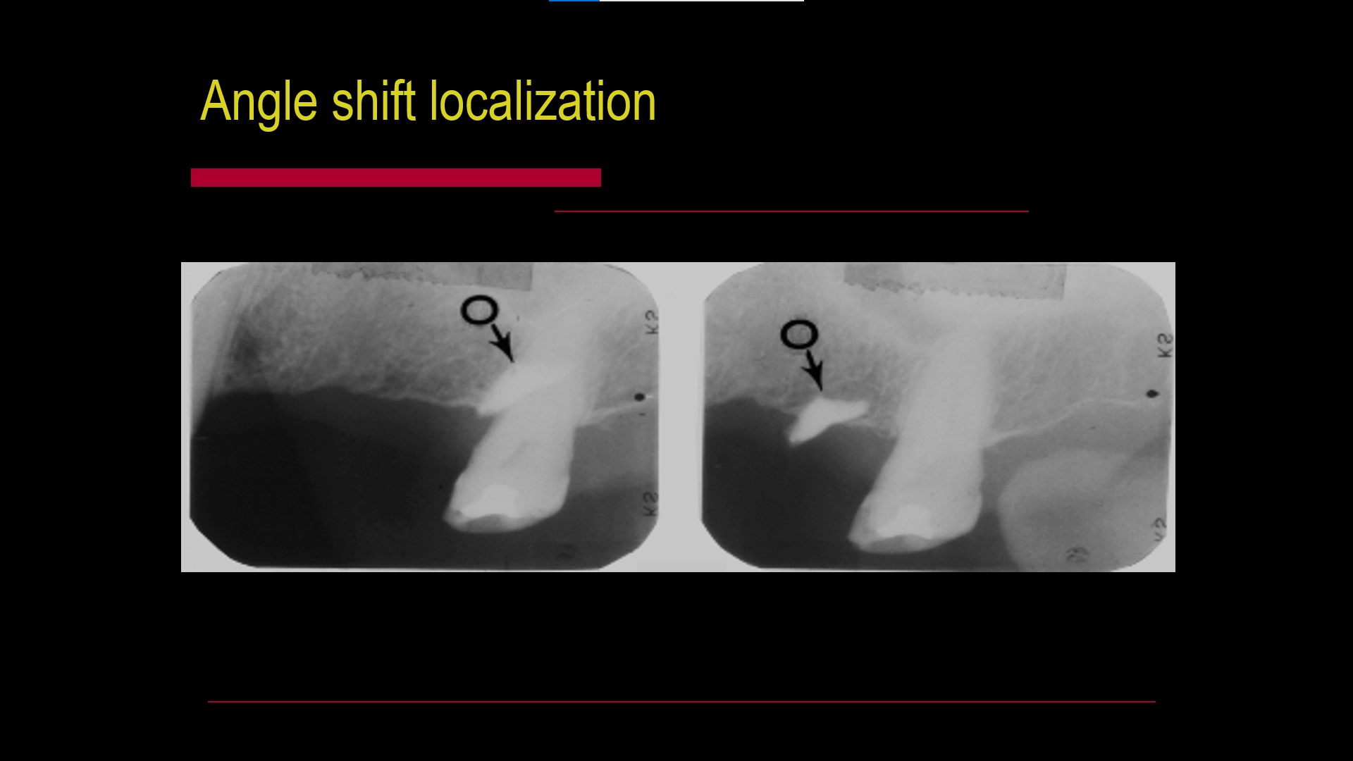 Impacted teeth5