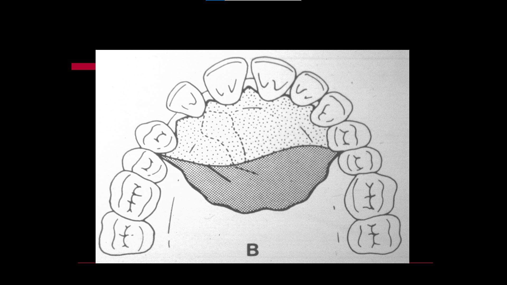 Impacted teeth5