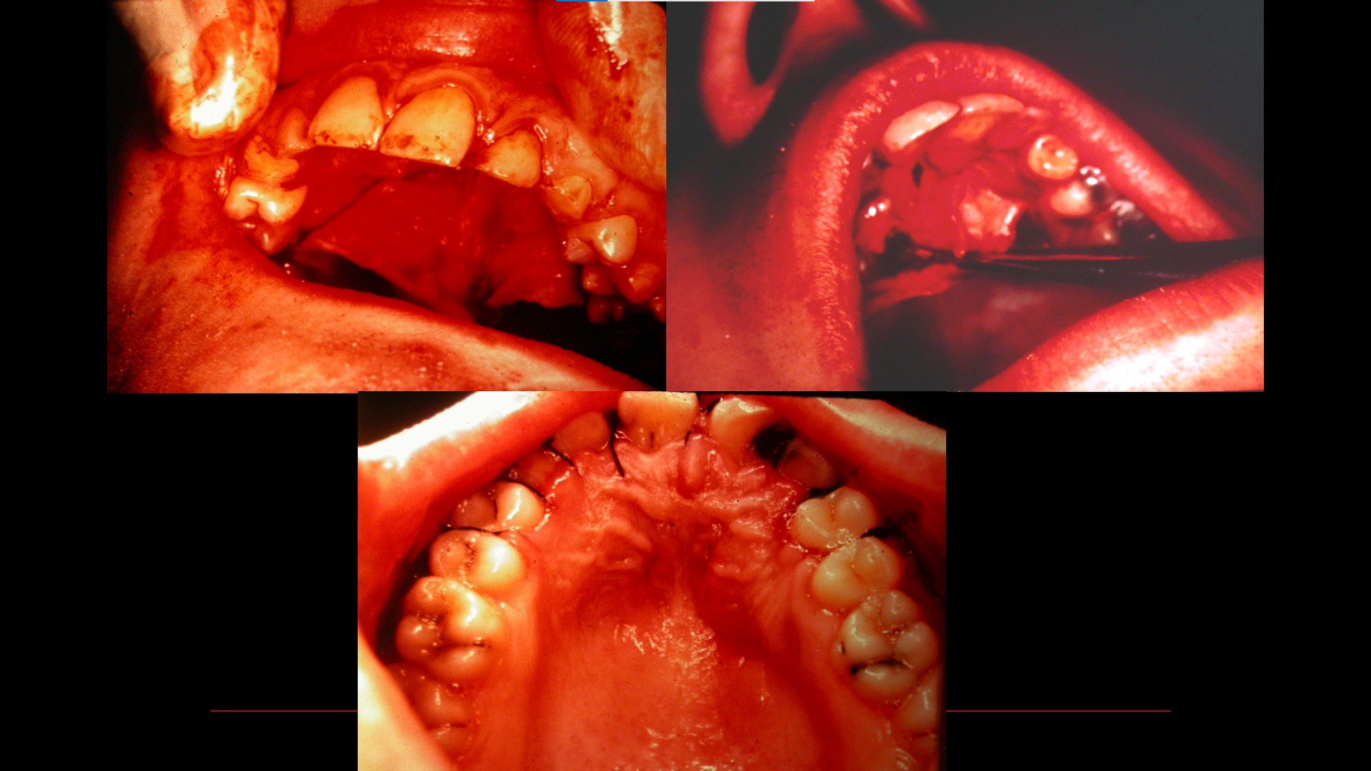 Impacted teeth5