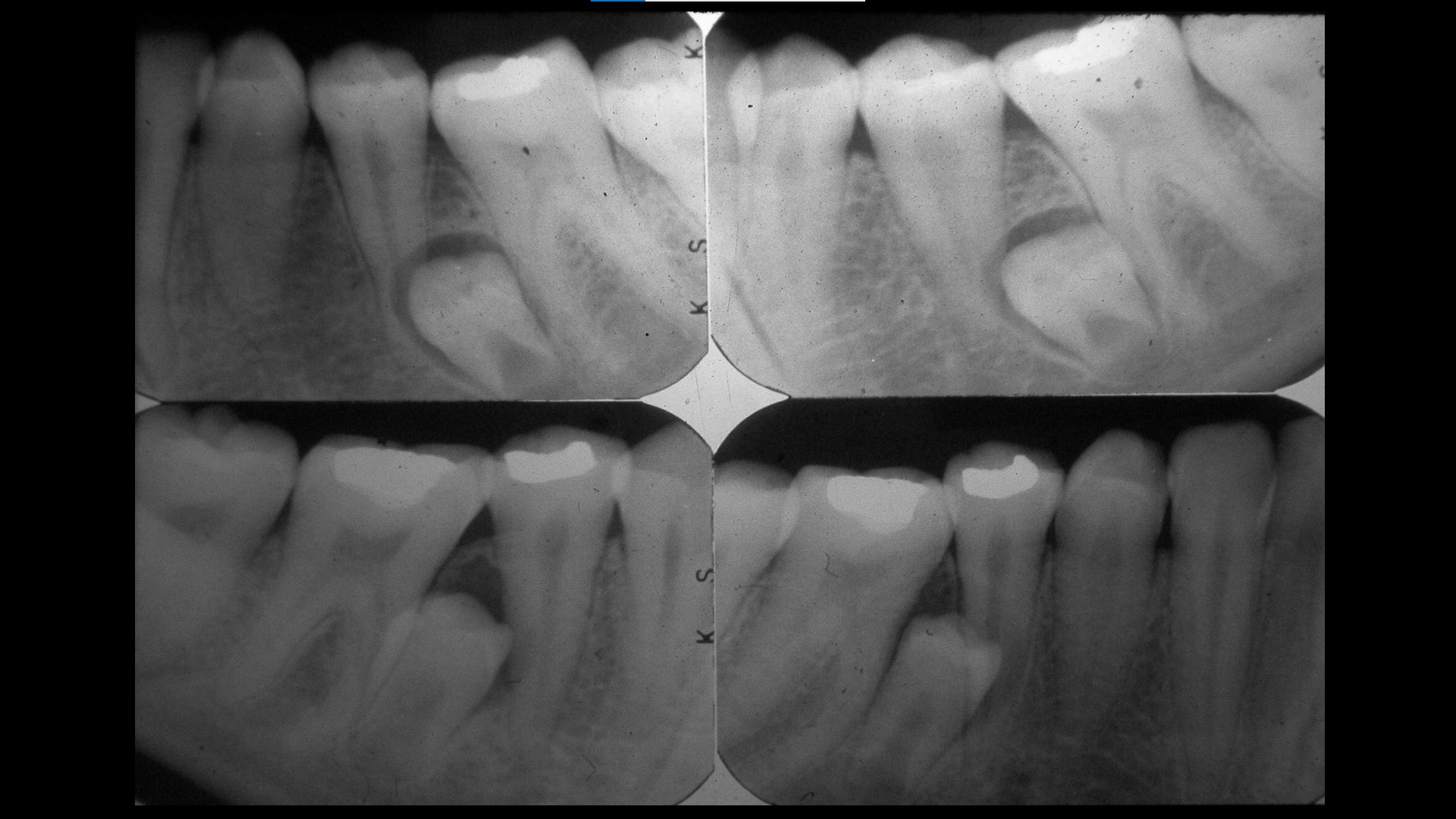 Impacted teeth5