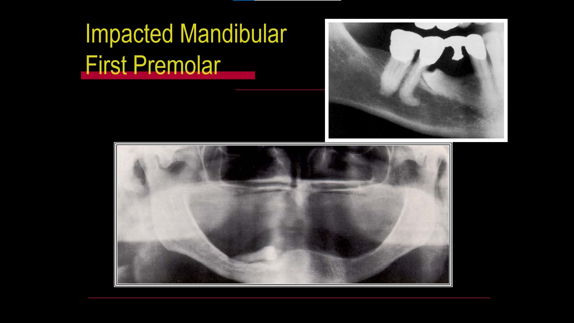 Impacted teeth5