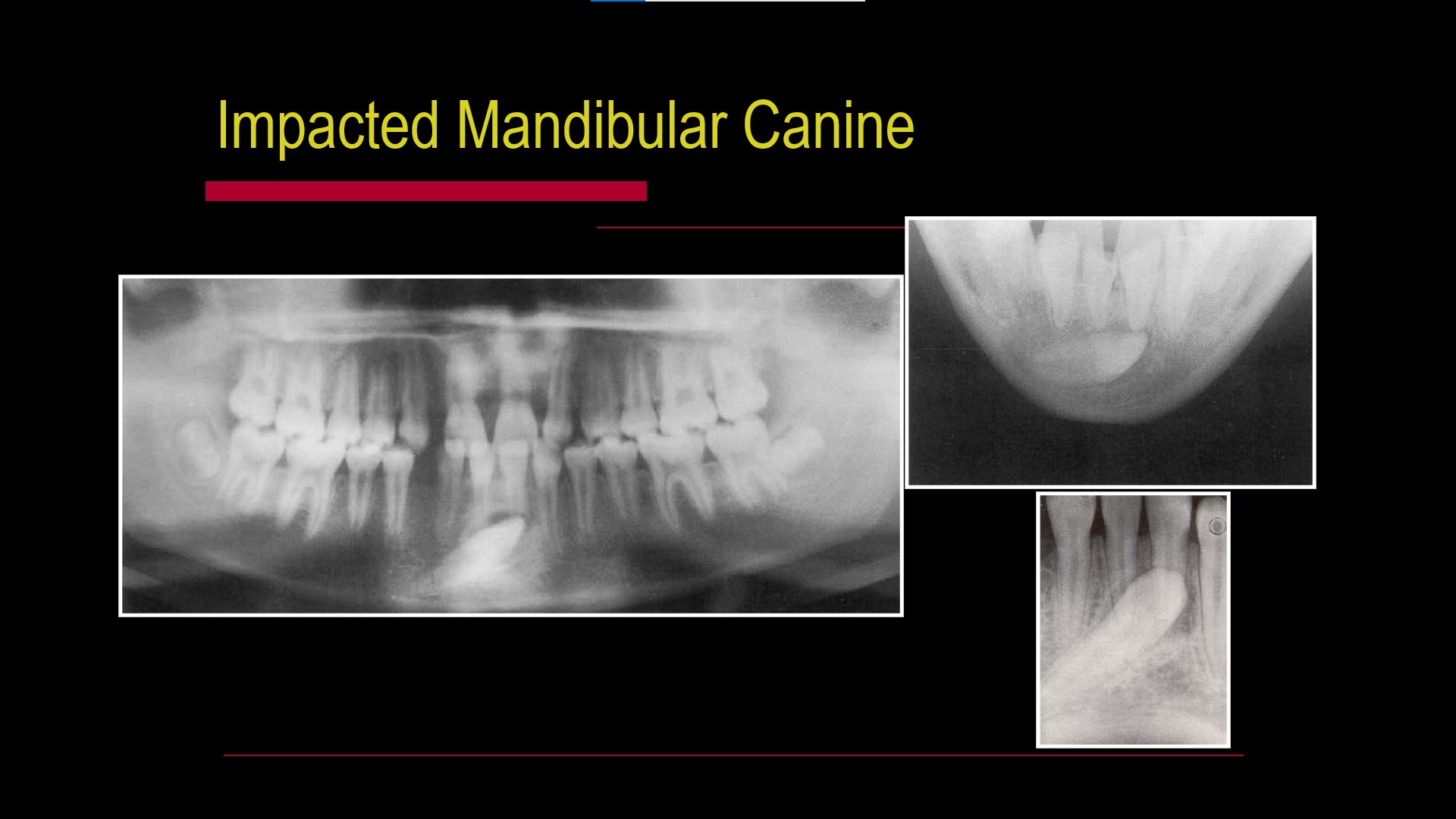 Impacted teeth5