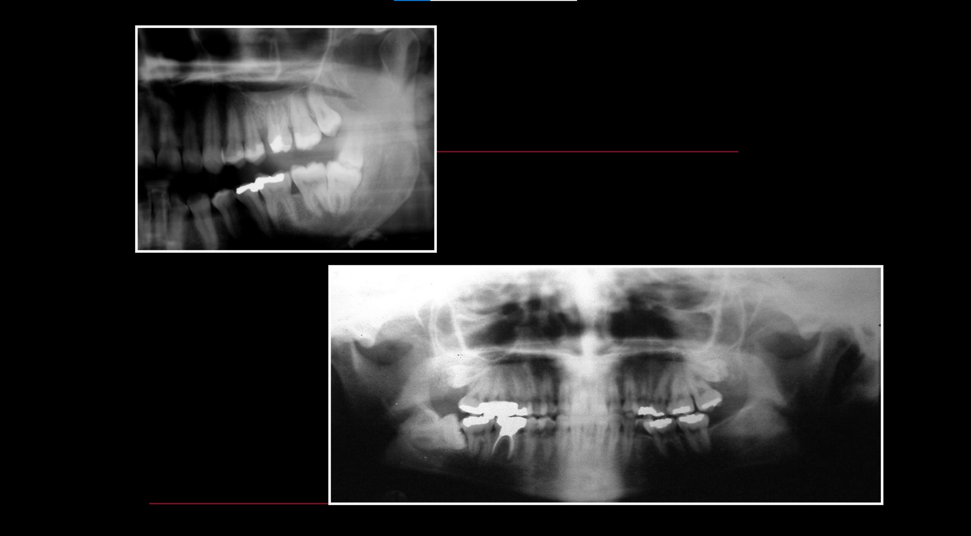 Impacted teeth1