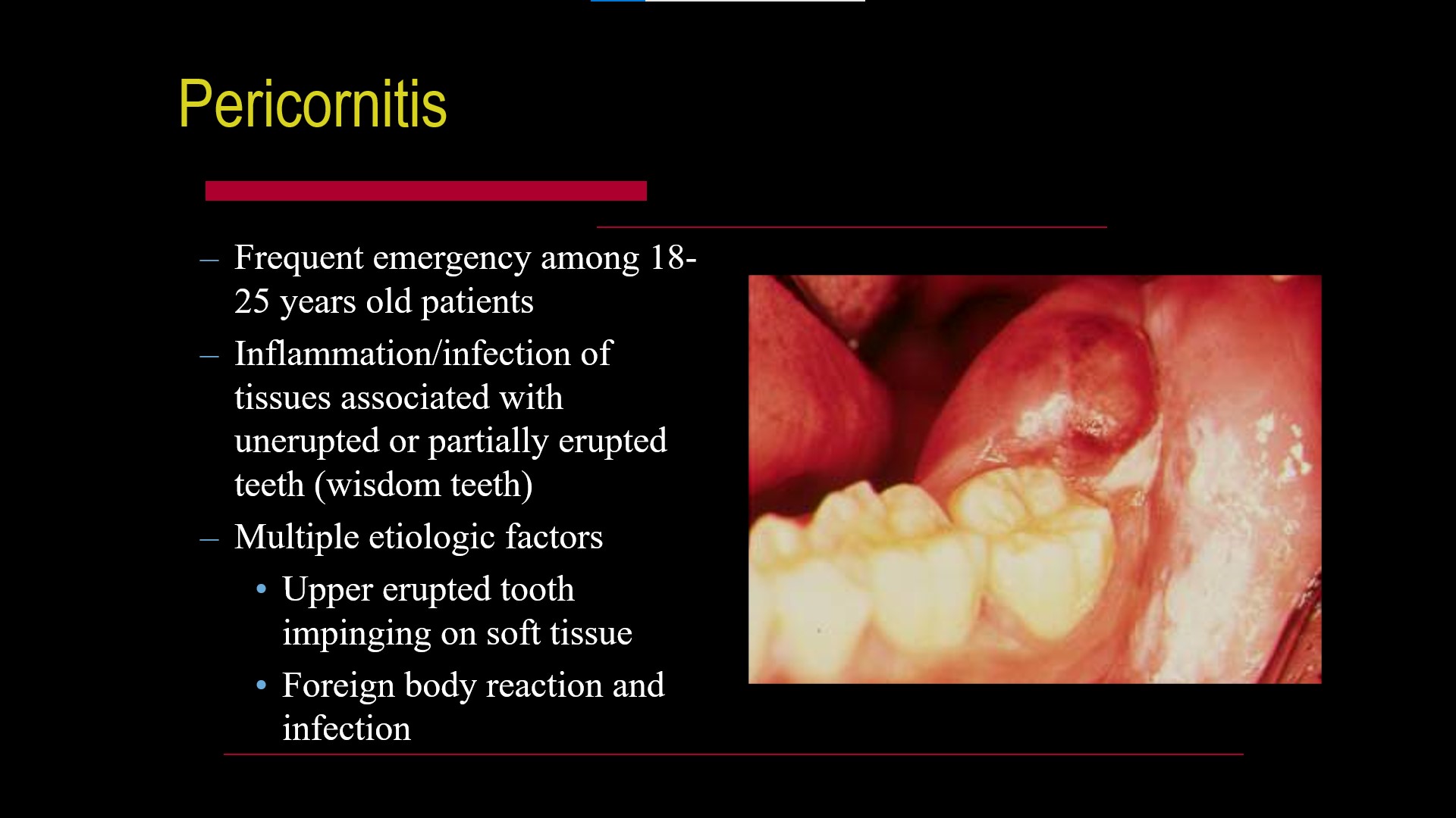 Impacted teeth1