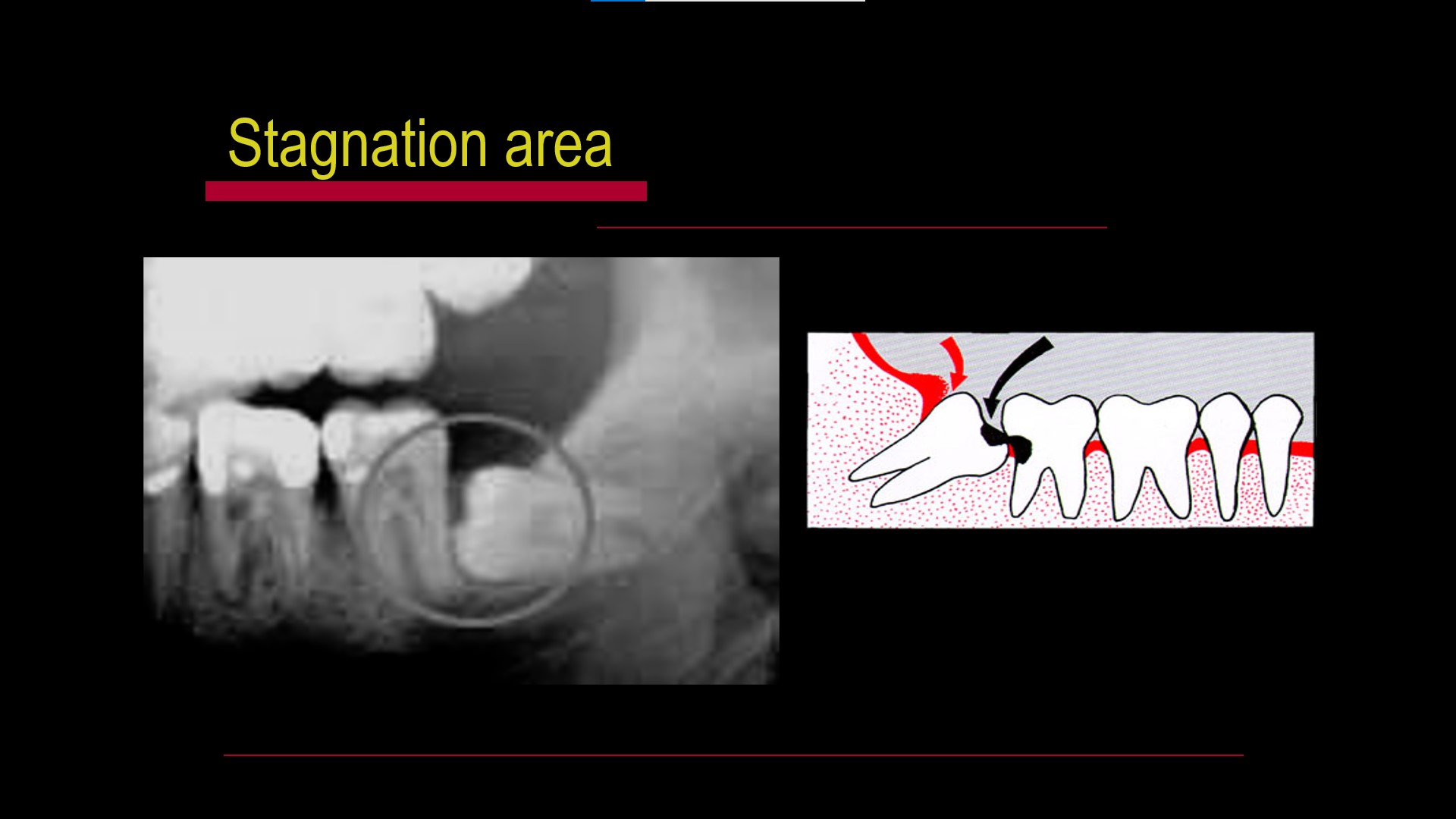 Impacted teeth1