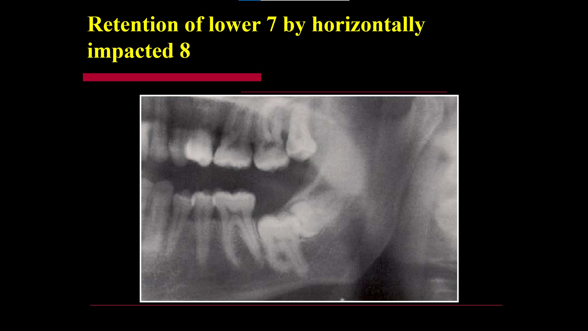 Impacted teeth1