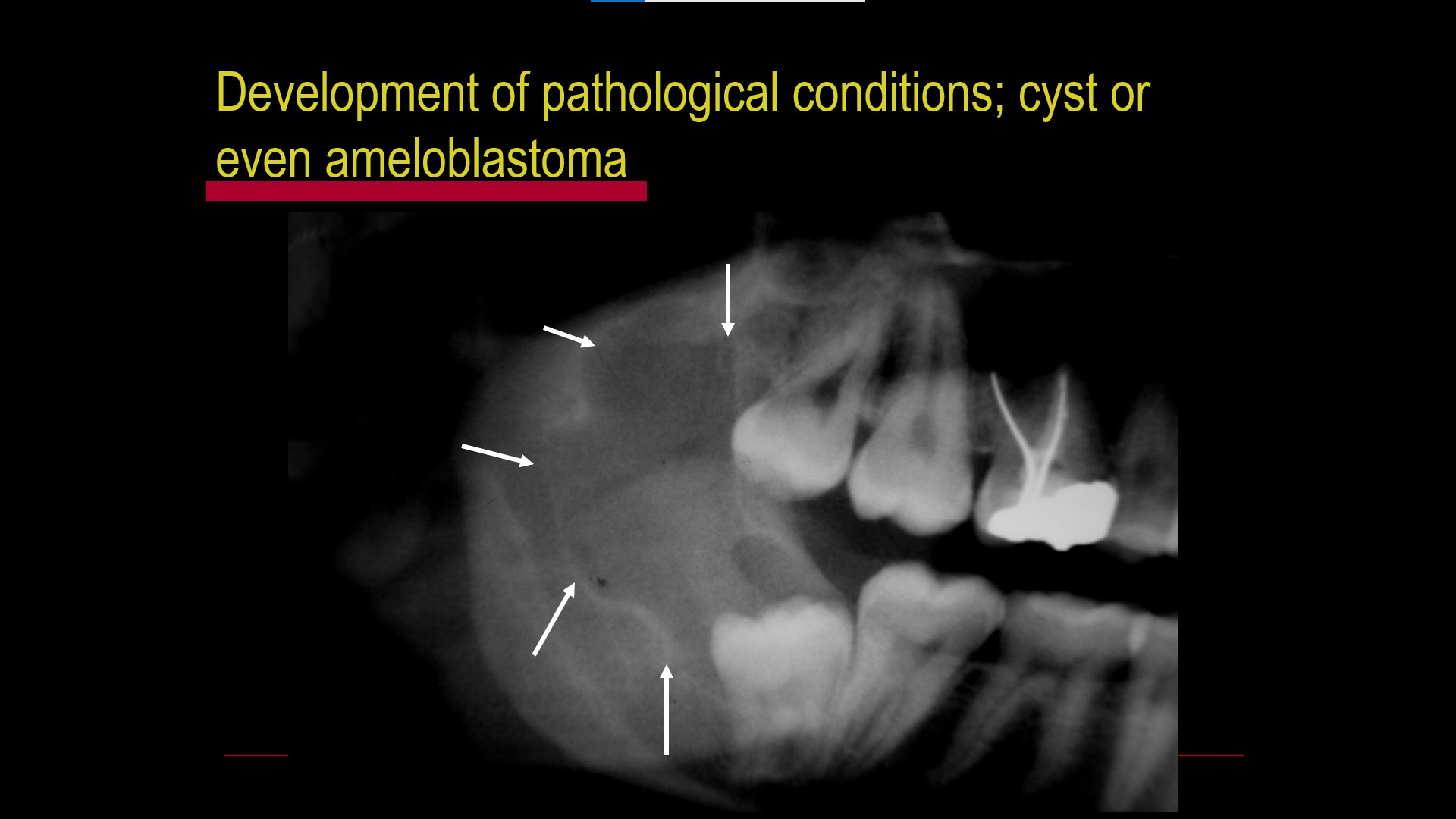 Impacted teeth1