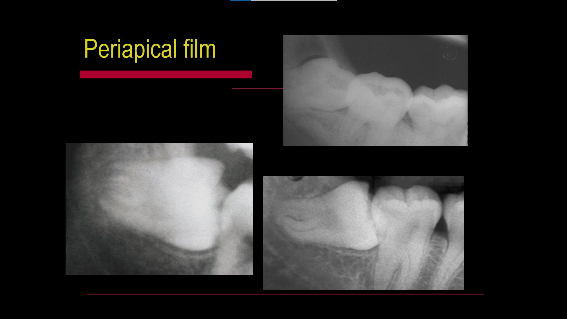 Impacted teeth1