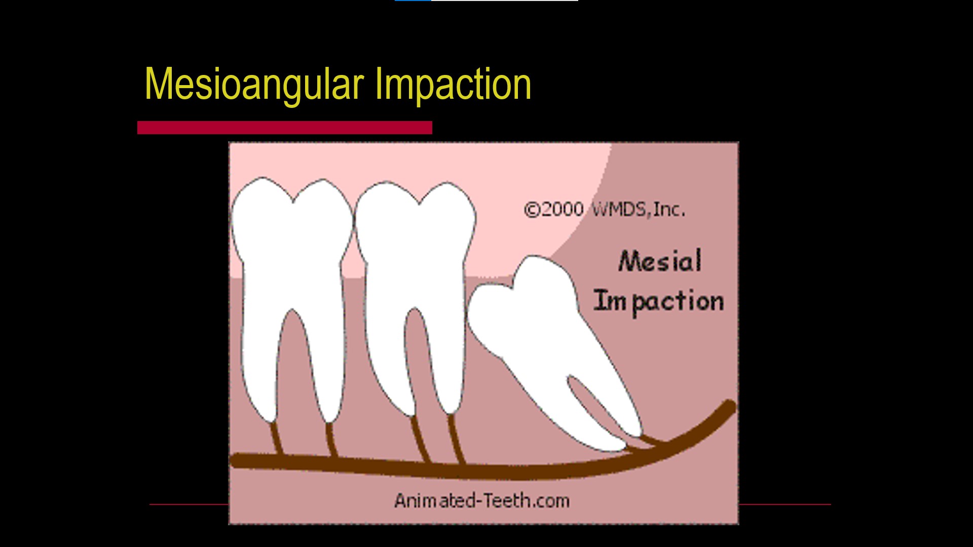 Impacted teeth2