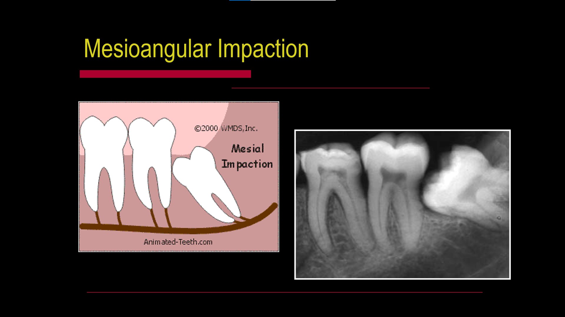 Impacted teeth2