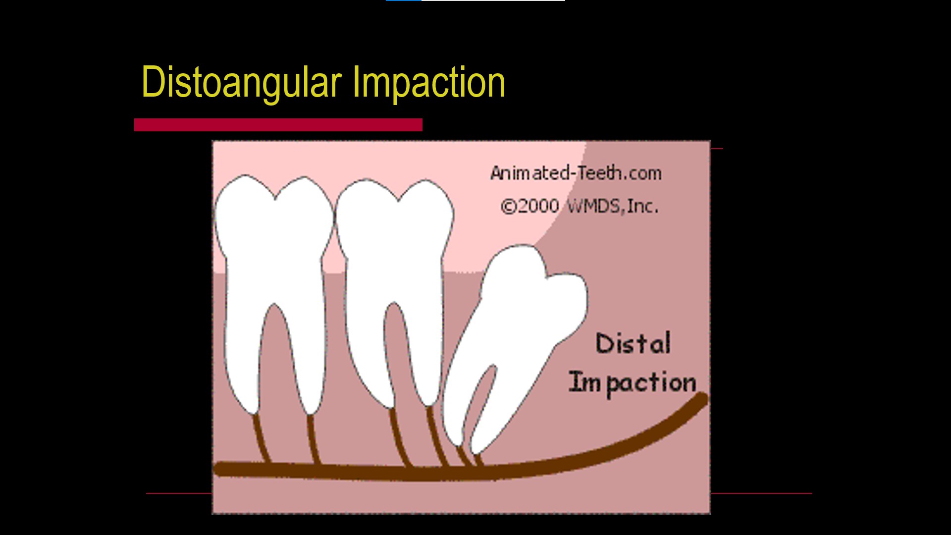 Impacted teeth2