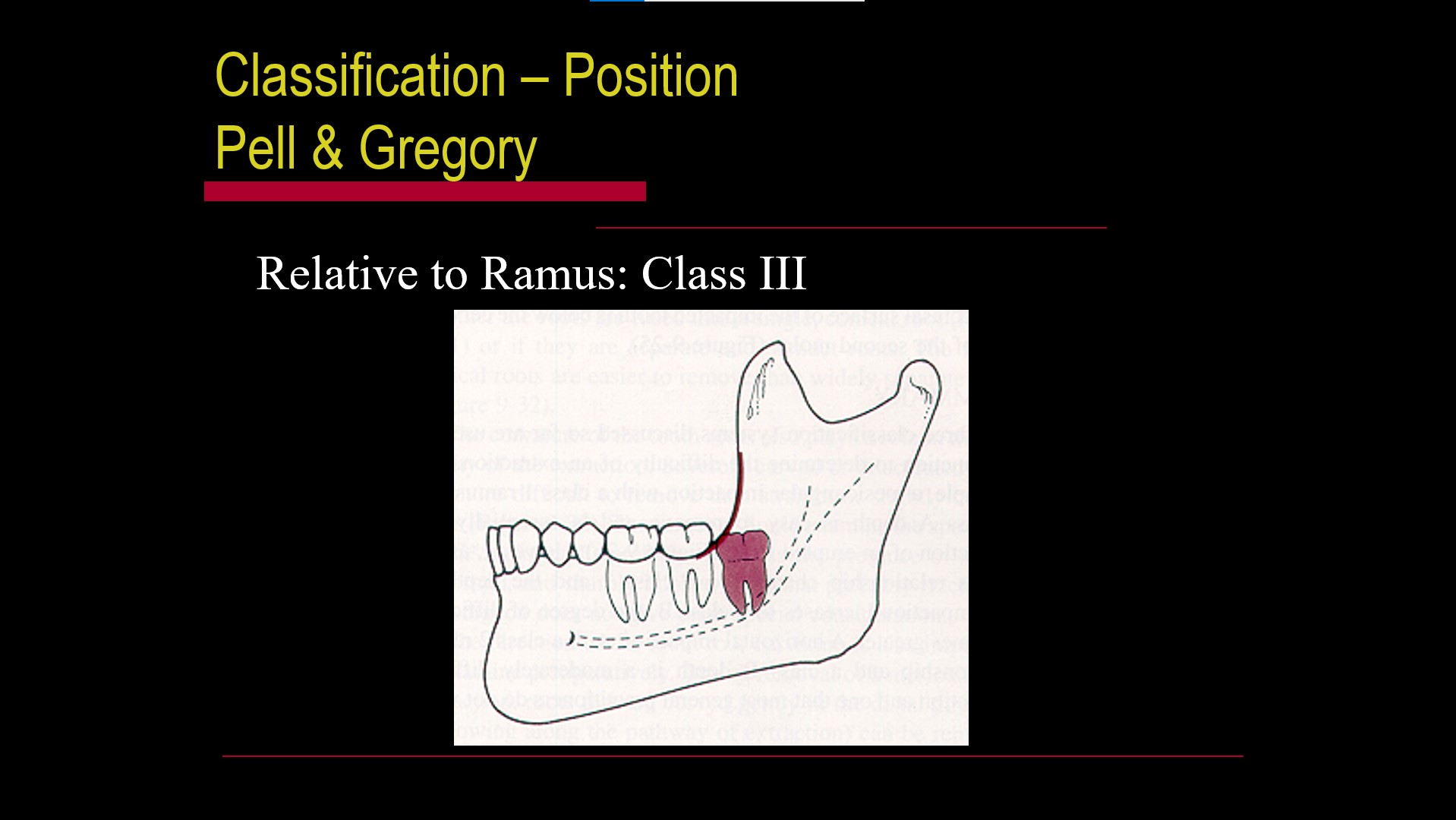 Impacted teeth2