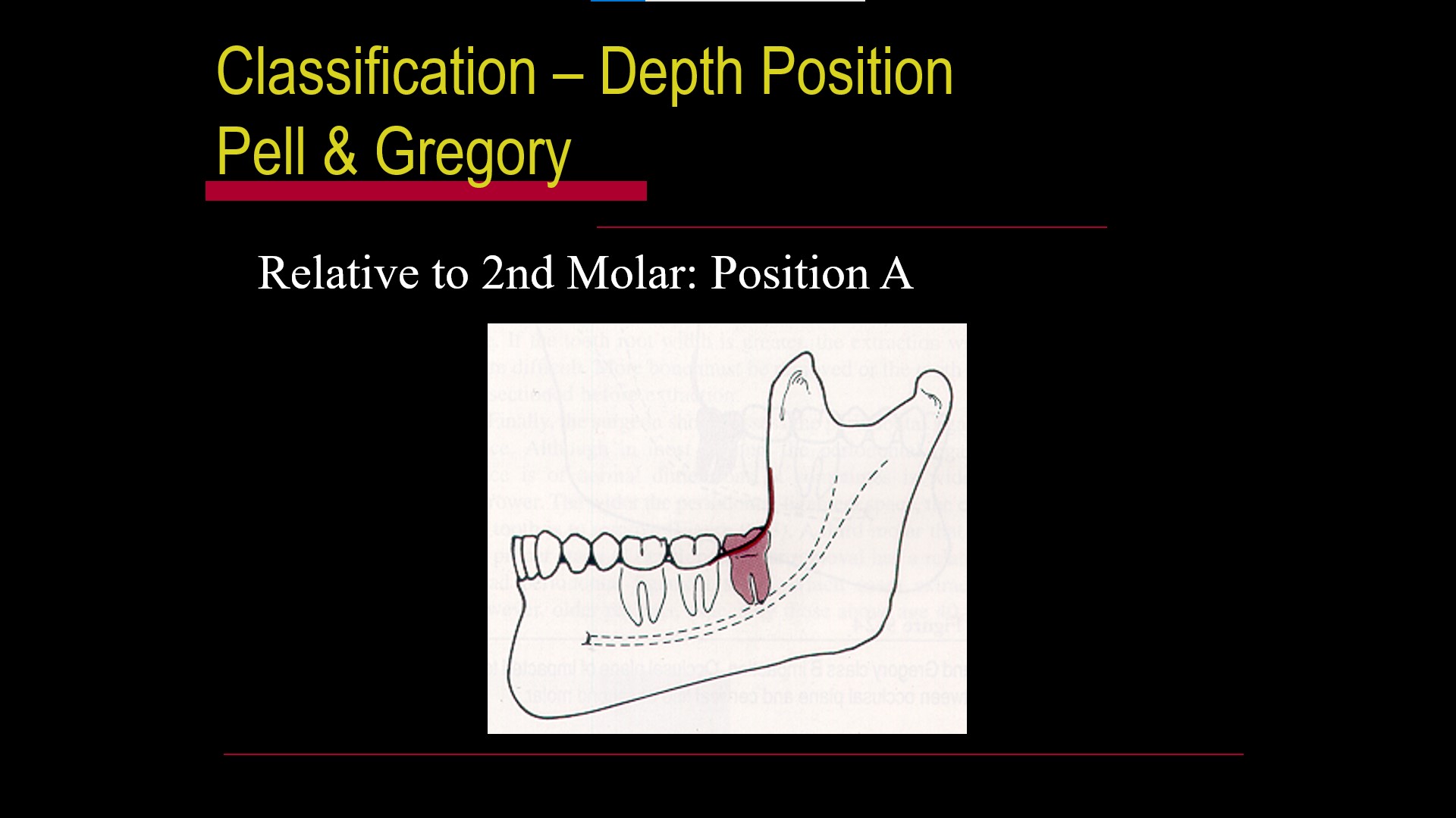 Impacted teeth2