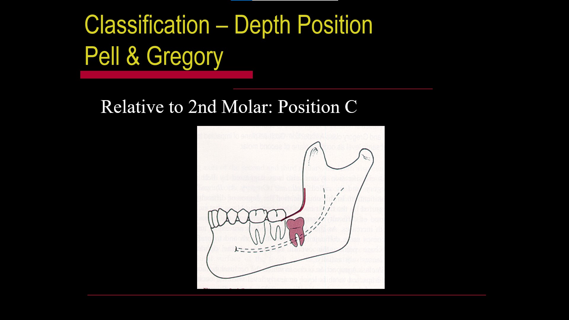 Impacted teeth2