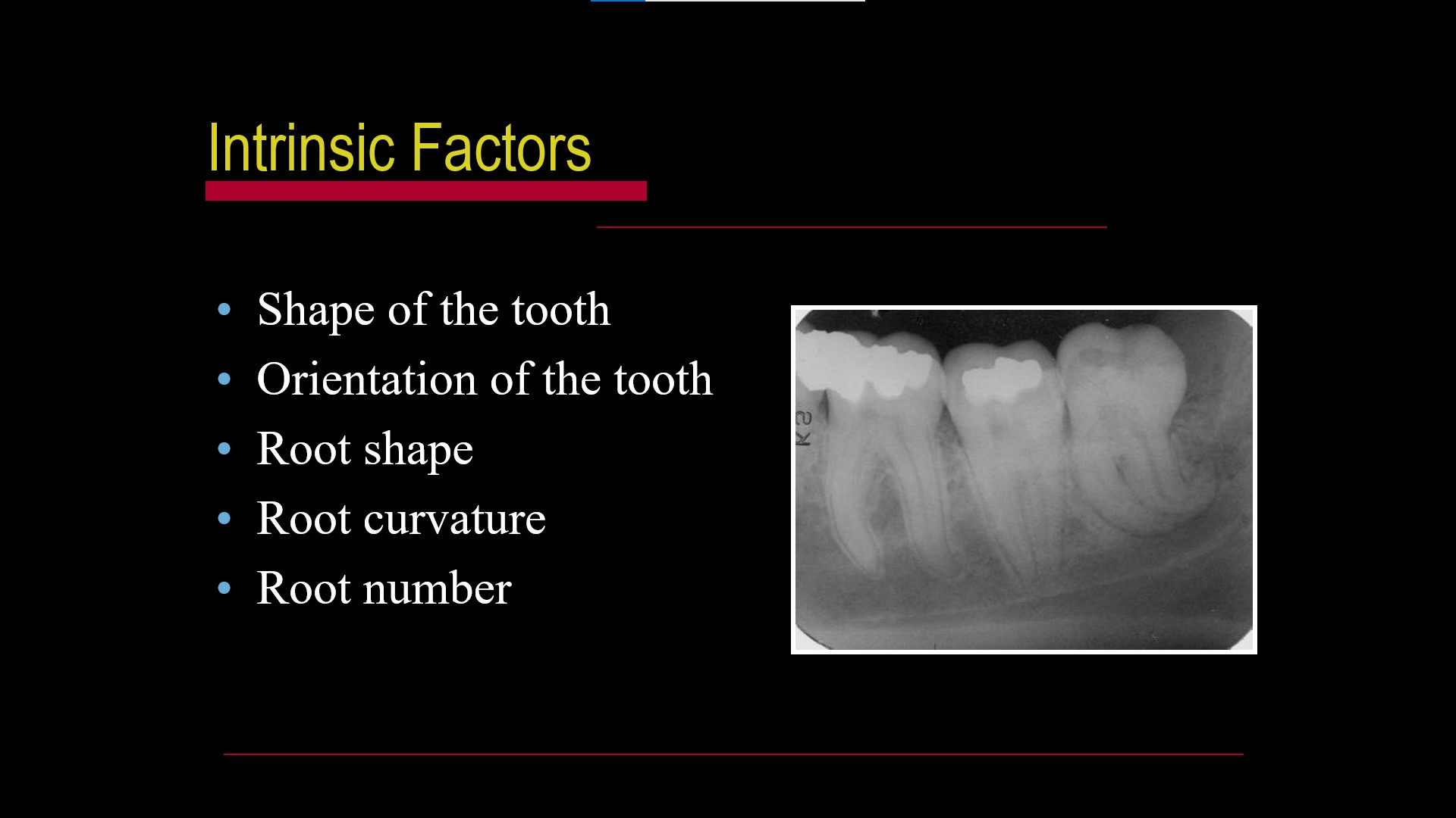 Impacted teeth3