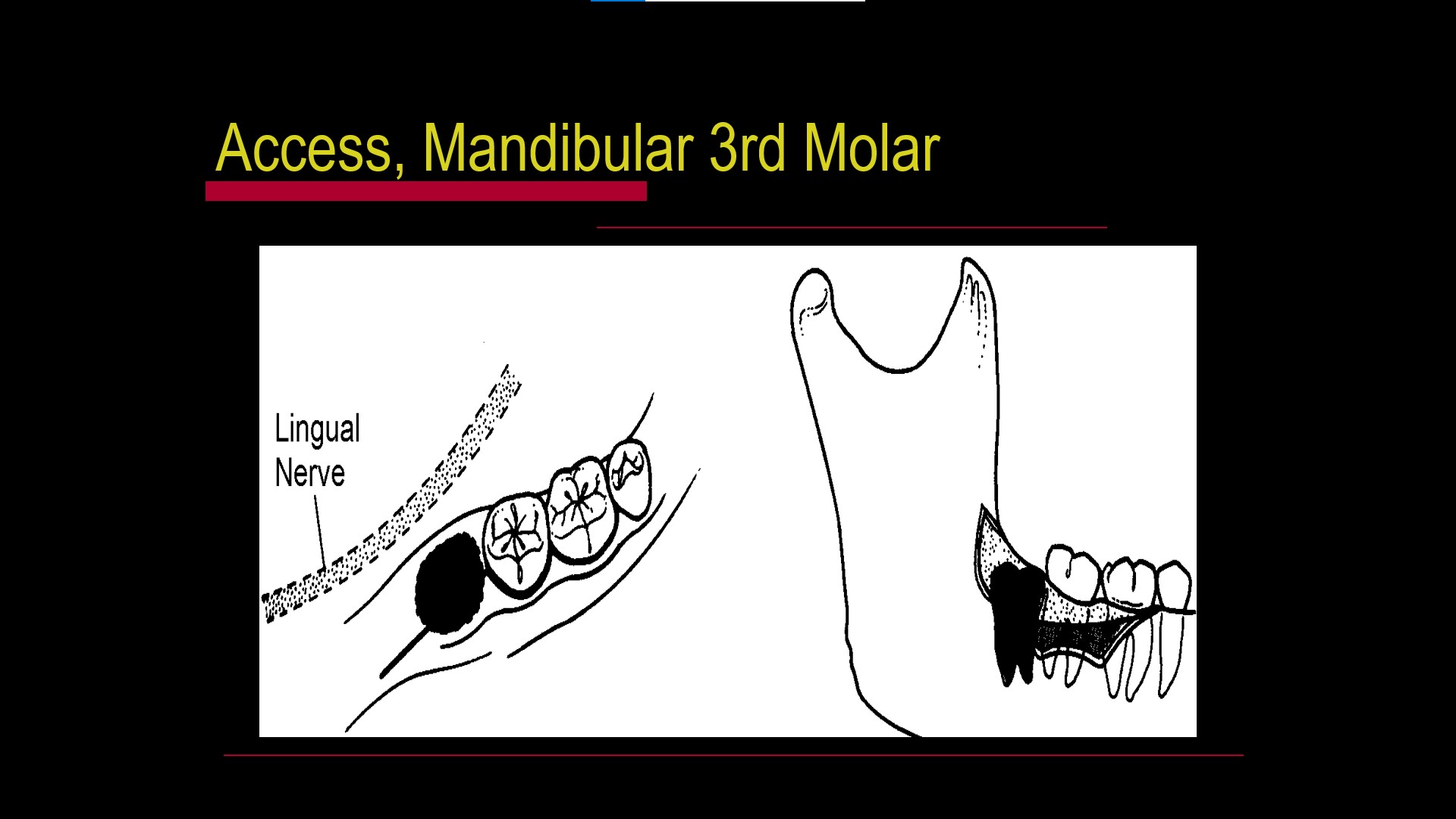 Impacted teeth3