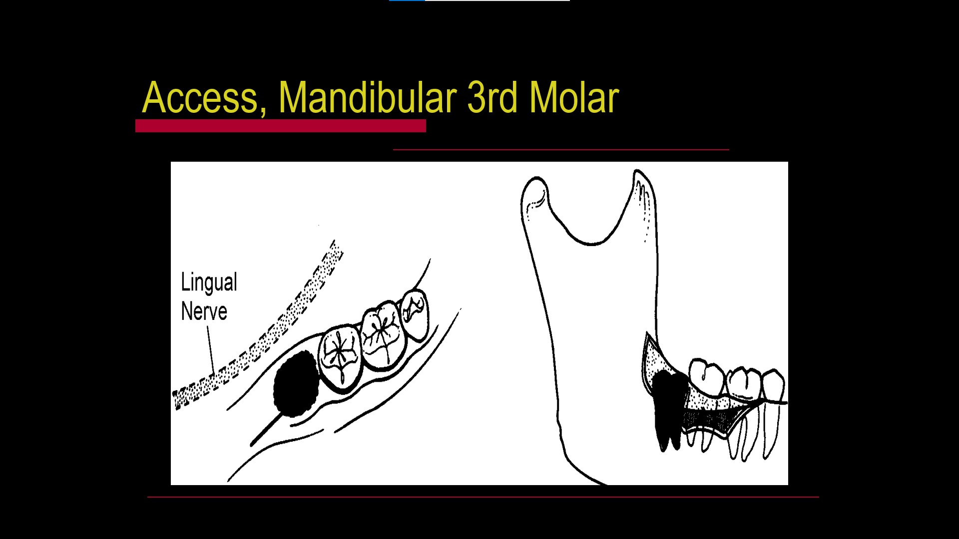 Impacted teeth3