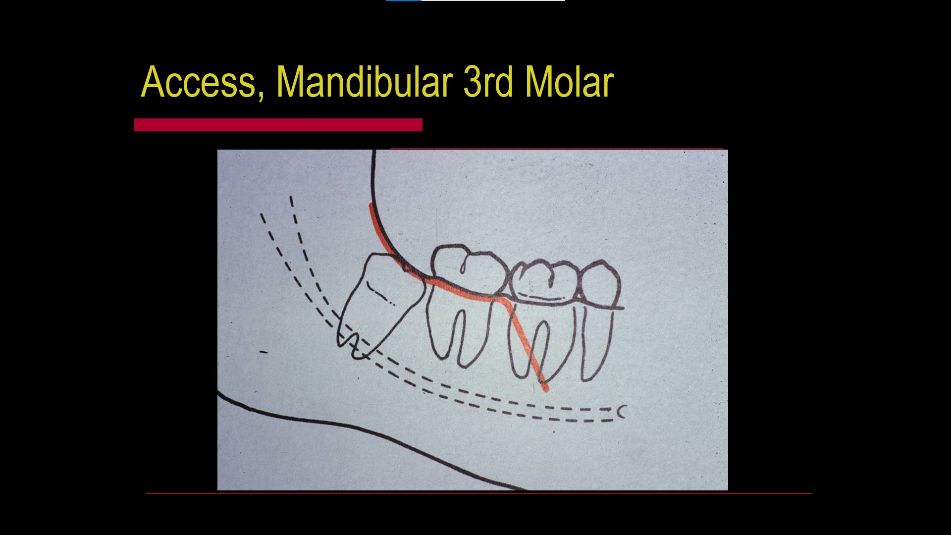 Impacted teeth3