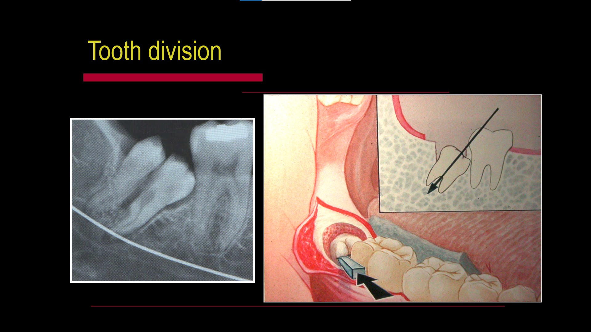 Impacted teeth4